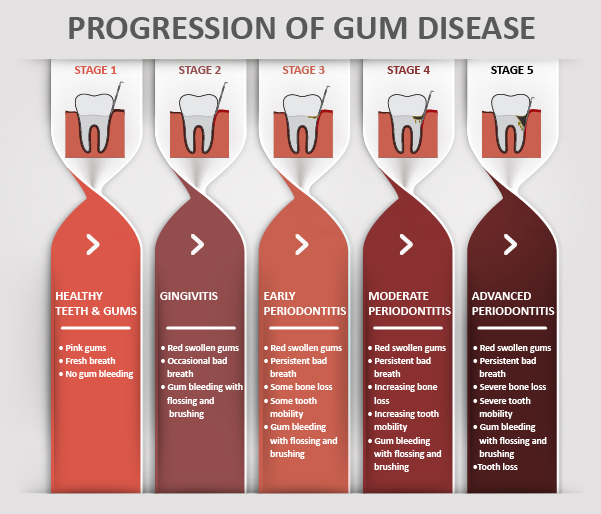 Minneapolis Dentist Gum Disease