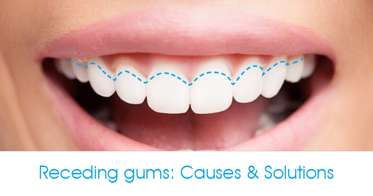 Smile with receding gums causes and solutions