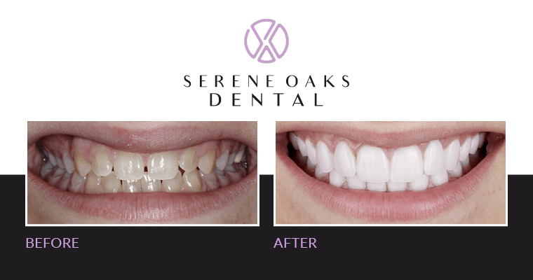 Patient with weak enamel before and after prepless veneers. 