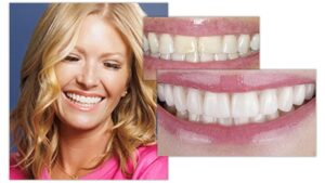 Transform Your Smile with Veneers